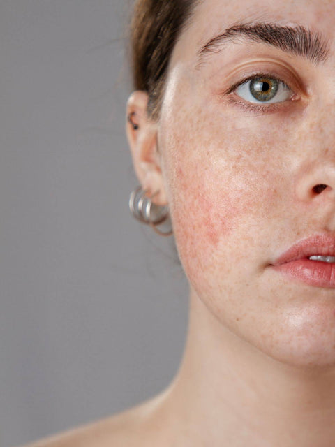 Understanding The Underlying Causes Of Rosacea