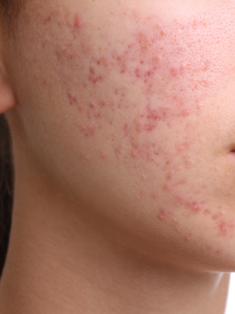 Fungal Acne vs Hormonal Acne