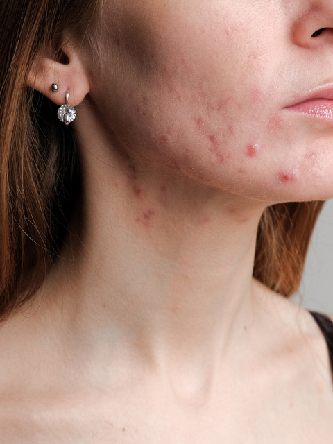 Hormonal Acne